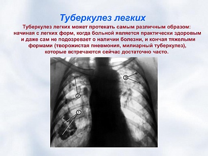 Туберкулёз - С„РѕС‚Рѕ 19