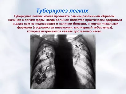 Туберкулёз - фото 19